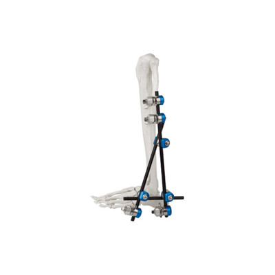 ankle joint external fixator, orthopedic instruments, bone fracture